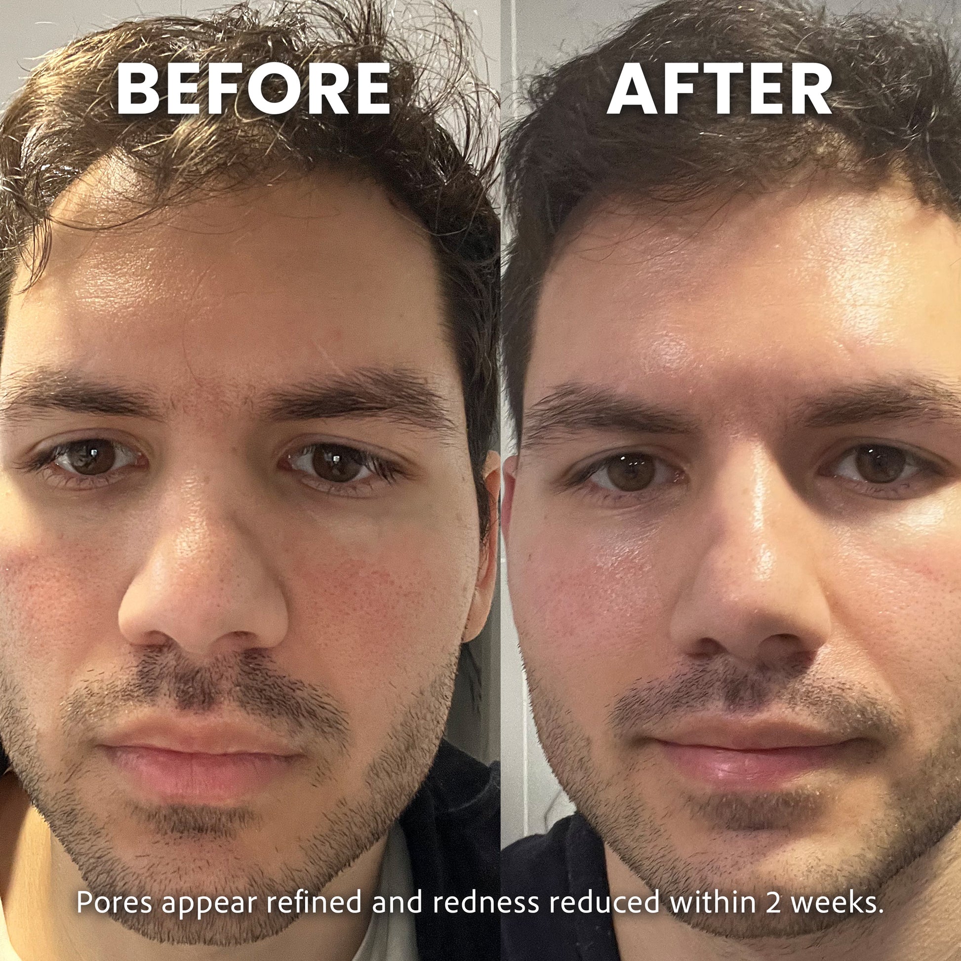 Niacinamide 10% Brightening Serum | Pores, Tone & Fine Lines in 30 Days